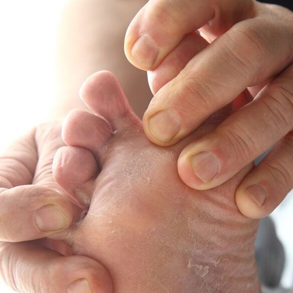 A gomba a lábujjak közötti bőrt érinti