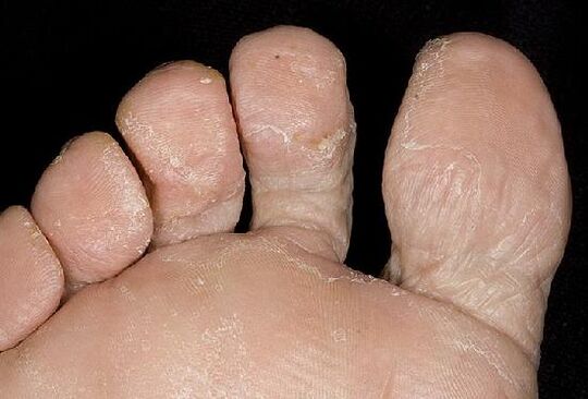 A gombás fertőzés megnyilvánulásai a lábakon