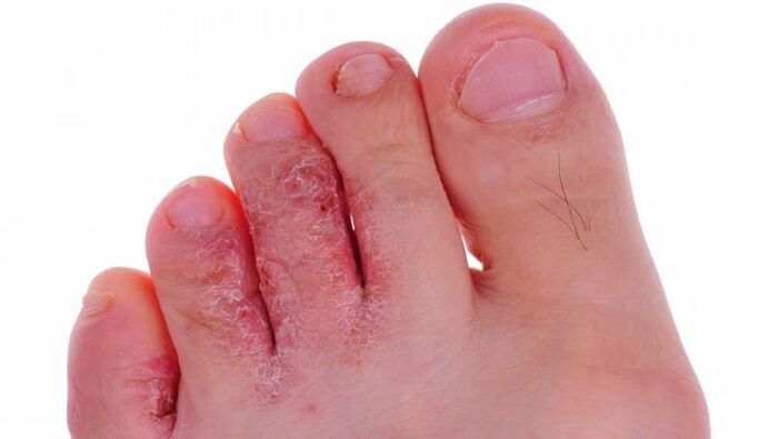 a lábujjak bőrének gombás fertőzése