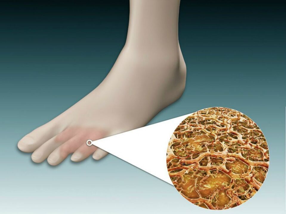 A lábujjak közötti és közeli bőrpír intertriginális gombával