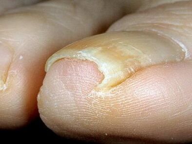 A gombával fertőzött lábkörmök megjelenése